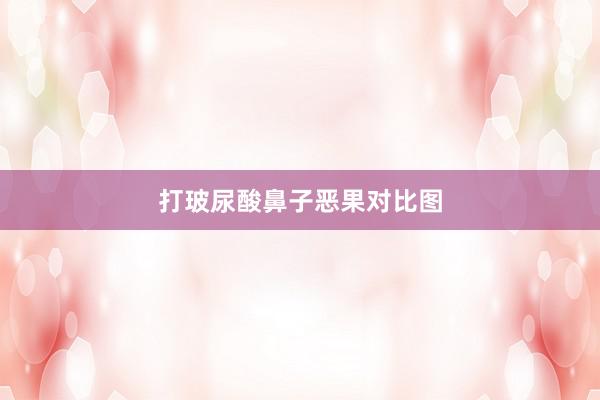 打玻尿酸鼻子恶果对比图